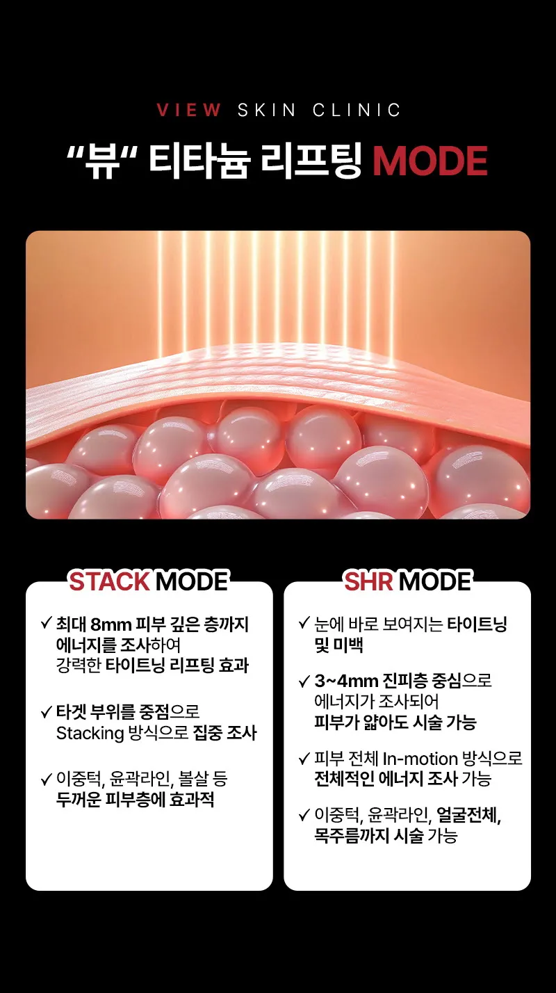 뷰성형외과 ❤뷰❤티타늄리프팅 이벤트, 시술 상세 이미지