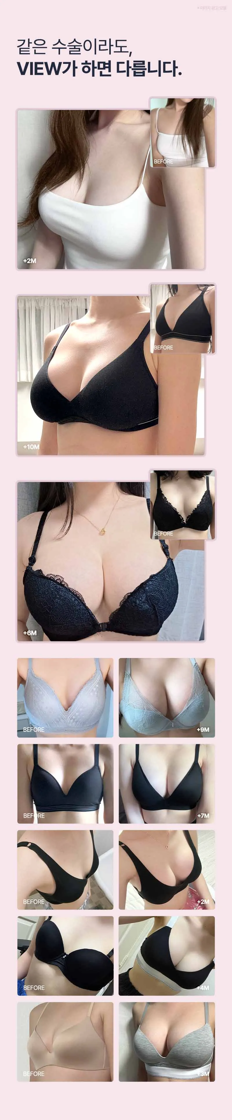 뷰성형외과 ❤️뷰❤️멘토 부스트 이벤트, 시술 상세 이미지