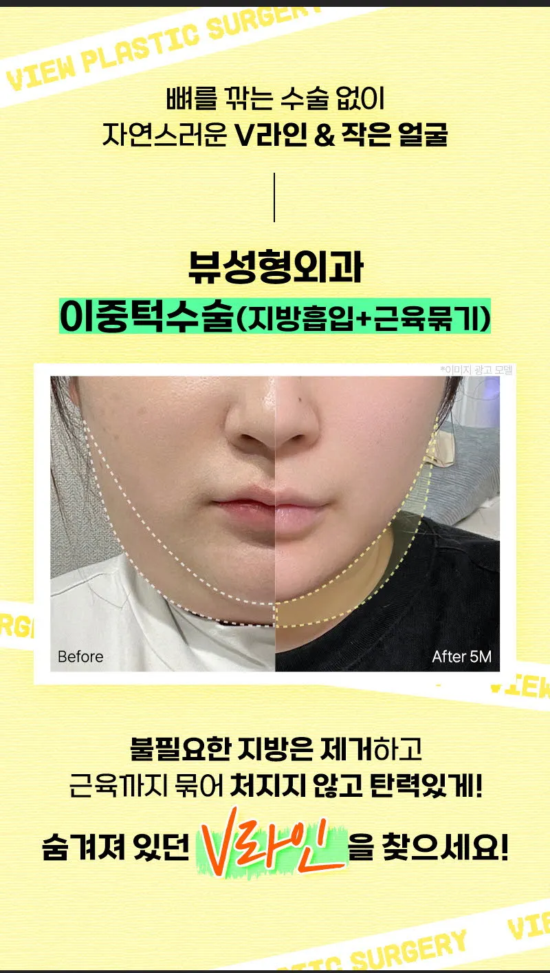 뷰성형외과 ❤뷰❤얼굴 지방흡입 이벤트, 시술 상세 이미지