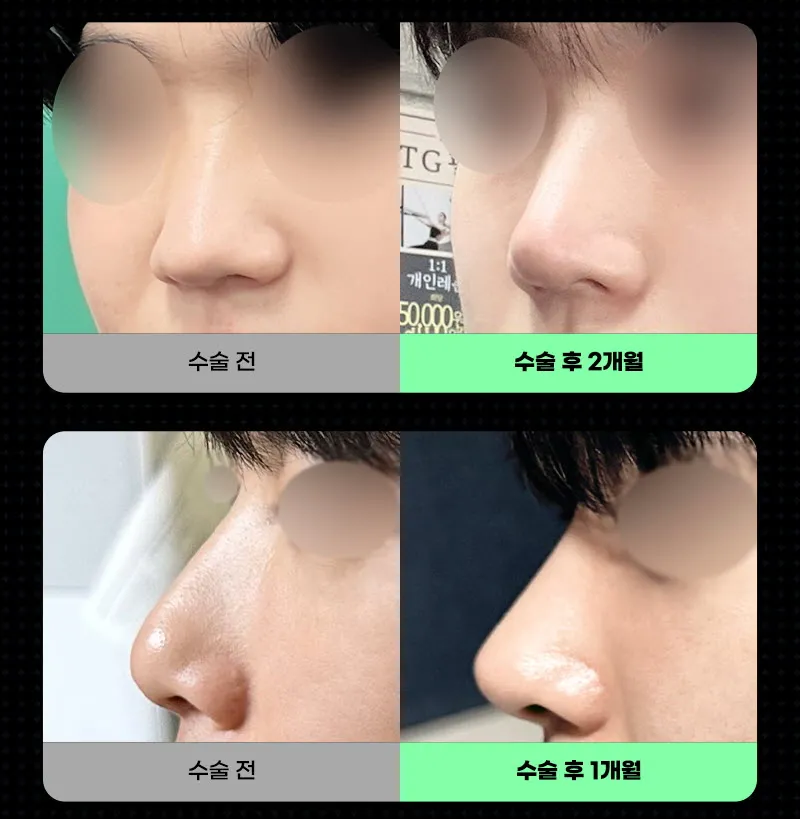 뷰성형외과 ❤️뷰❤️남자코성형 이벤트, 시술 상세 이미지