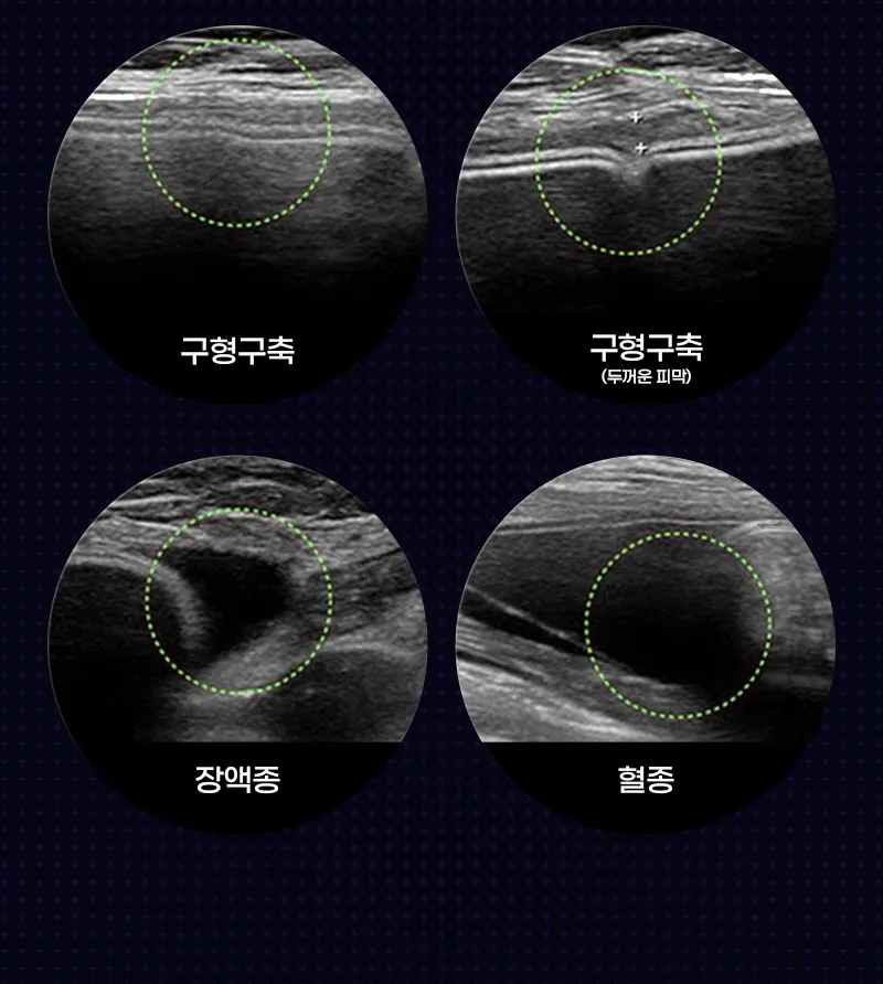 뷰성형외과 ❤뷰❤모티바 가슴 재수술 이벤트, 시술 상세 이미지