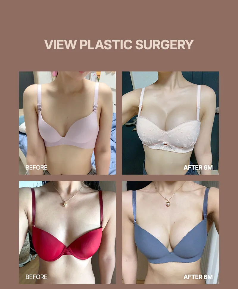 뷰성형외과 ❤뷰❤여의사 UIU 가슴성형 이벤트, 시술 상세 이미지