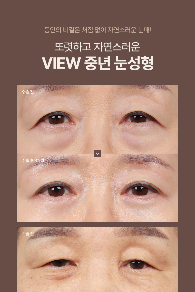 ❤️뷰❤️중년 눈성형