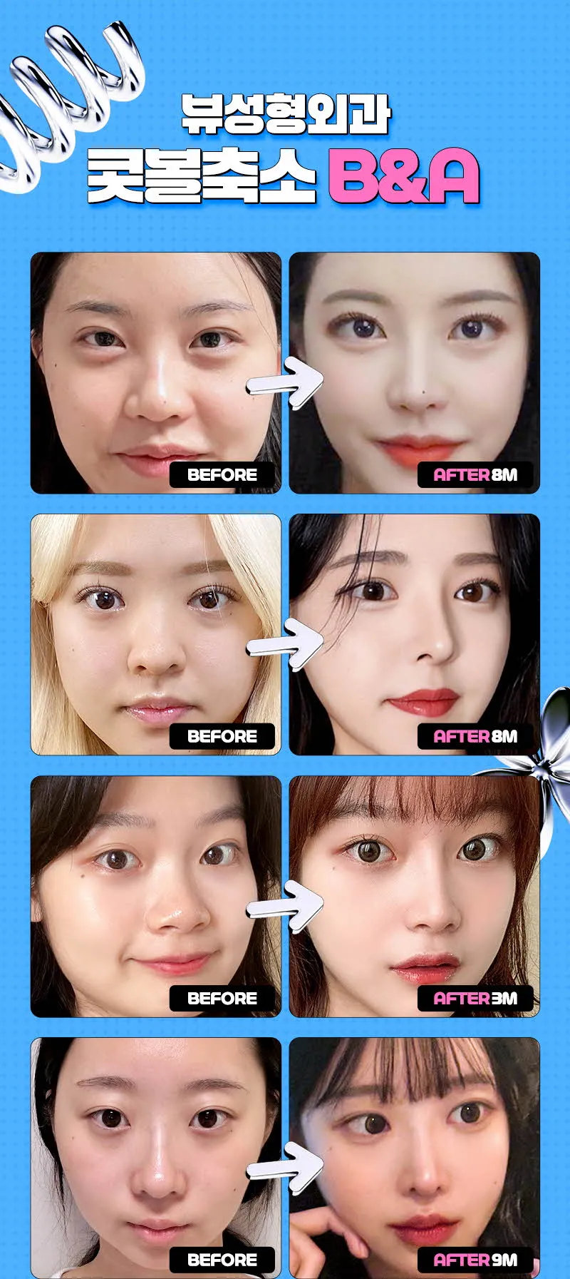 뷰성형외과 ❤️뷰❤️콧볼축소 이벤트, 시술 상세 이미지