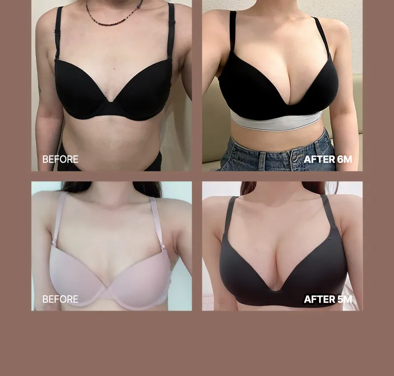 뷰성형외과 ❤뷰❤여의사 UIU 가슴성형 이벤트, 시술 상세 이미지