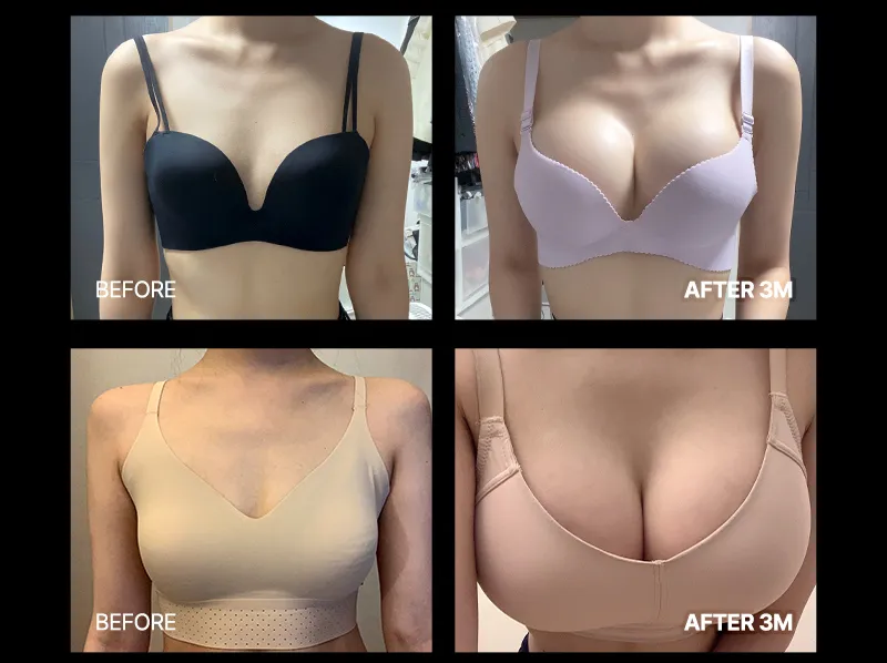 뷰성형외과 ❤뷰❤여의사 UIU 가슴성형 이벤트, 시술 상세 이미지