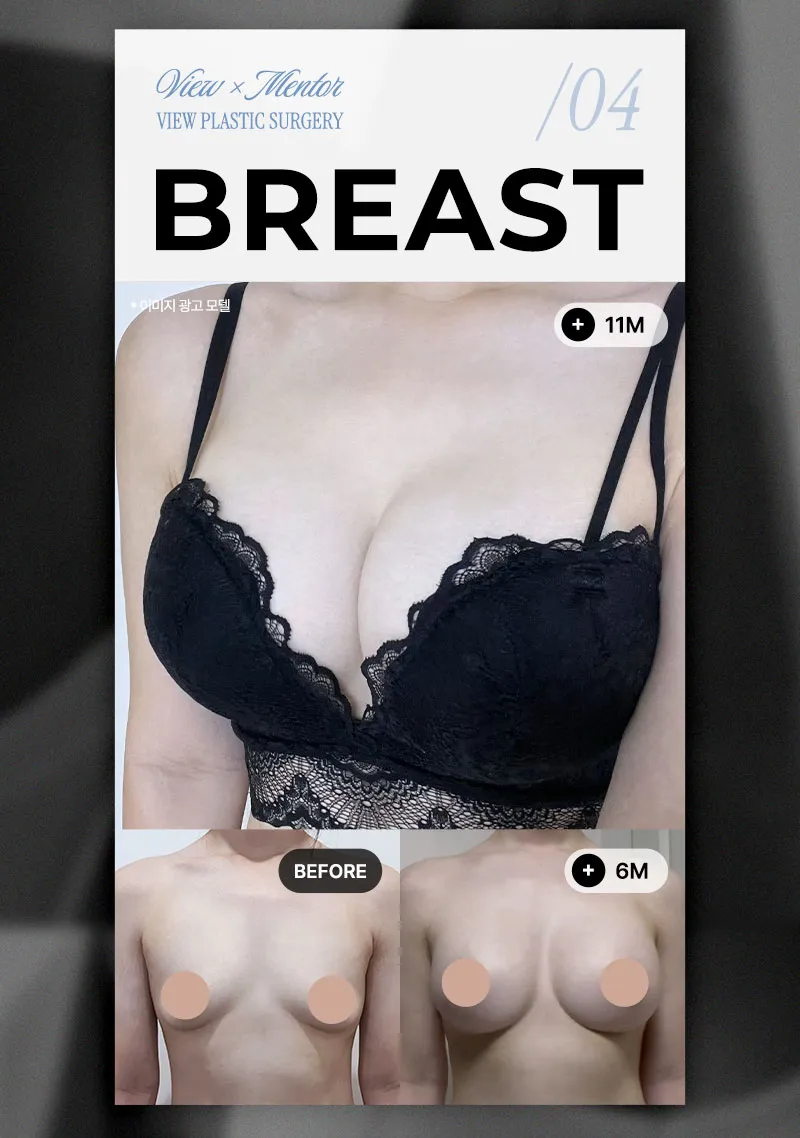 뷰성형외과 ❤️뷰❤️UIU 멘토 엑스트라 이벤트, 시술 상세 이미지