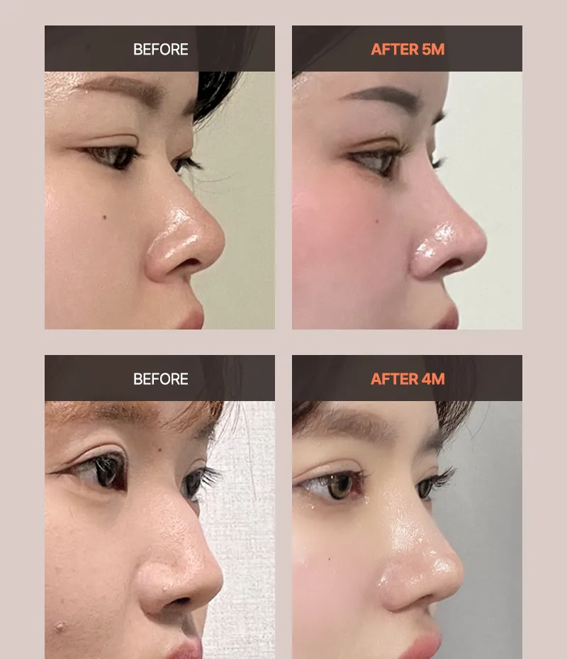 뷰성형외과 ❤️뷰❤️기능코성형 이벤트, 시술 상세 이미지