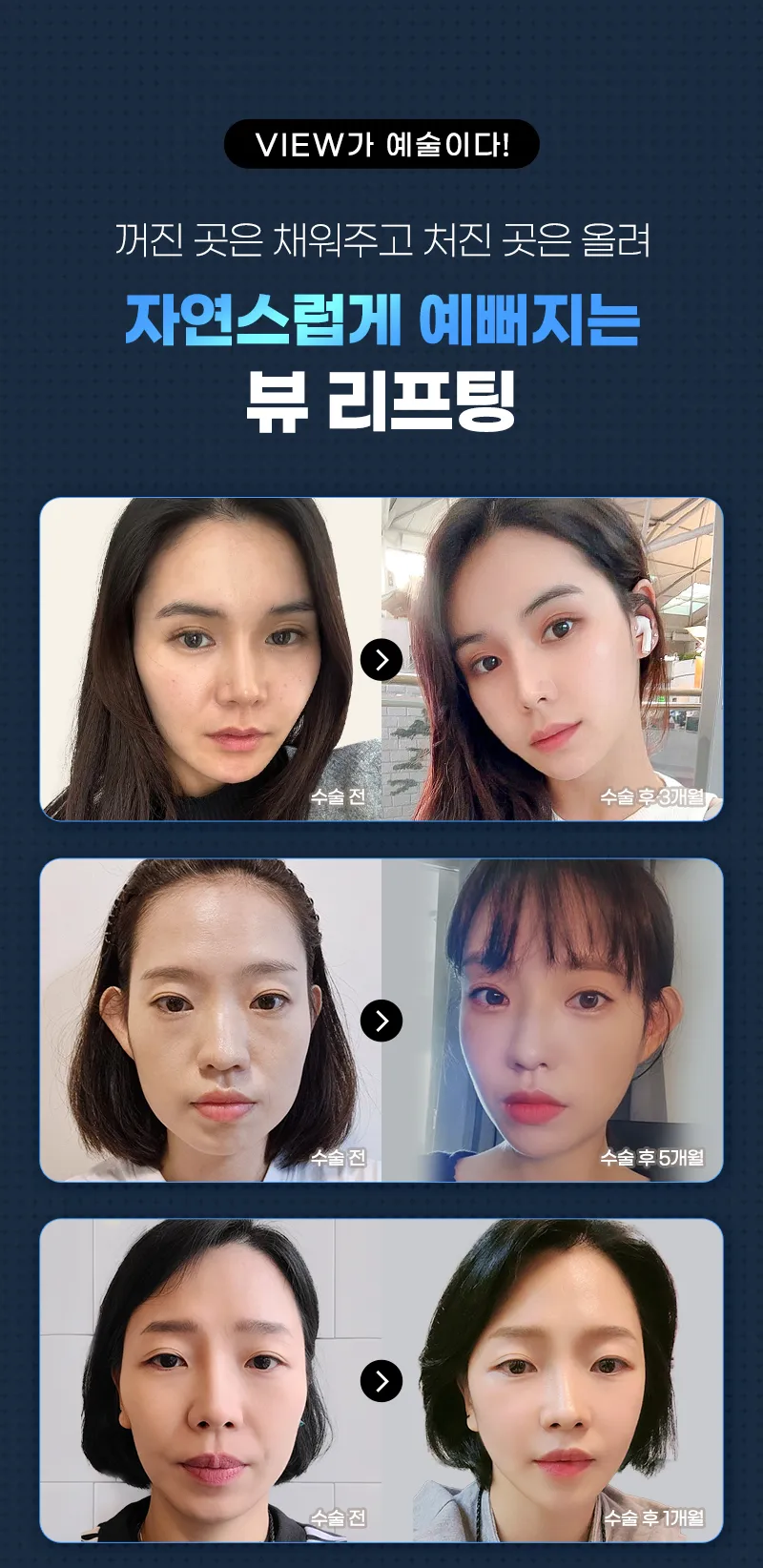 뷰성형외과 ❤️뷰❤️ 실리프팅 이벤트, 시술 상세 이미지