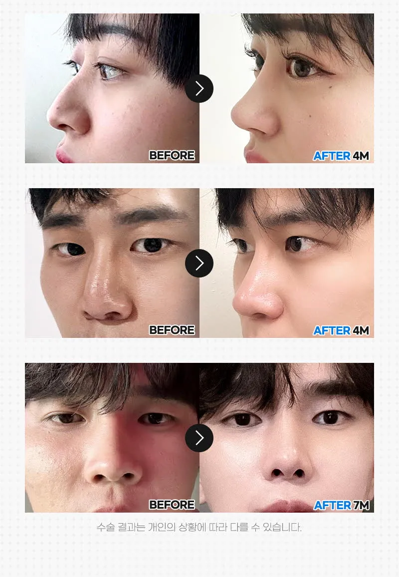 뷰성형외과 ❤️뷰❤️복코성형 이벤트, 시술 상세 이미지