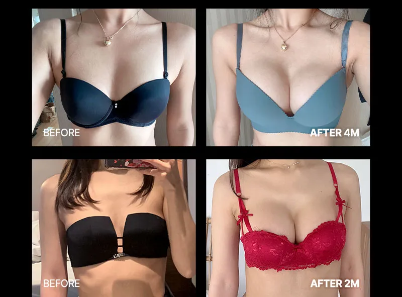 뷰성형외과 ❤뷰❤여의사 UIU 가슴성형 이벤트, 시술 상세 이미지