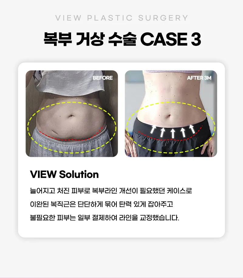 뷰성형외과 ❤뷰❤복부거상술 이벤트, 시술 상세 이미지