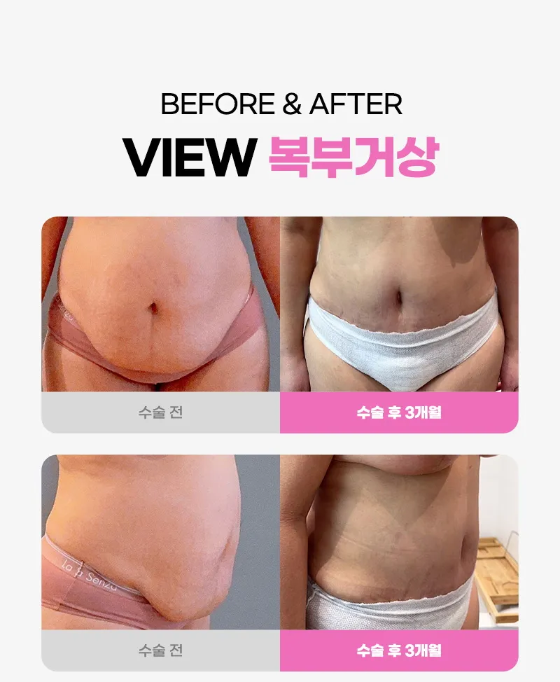 뷰성형외과 ❤뷰❤복부거상술 이벤트, 시술 상세 이미지