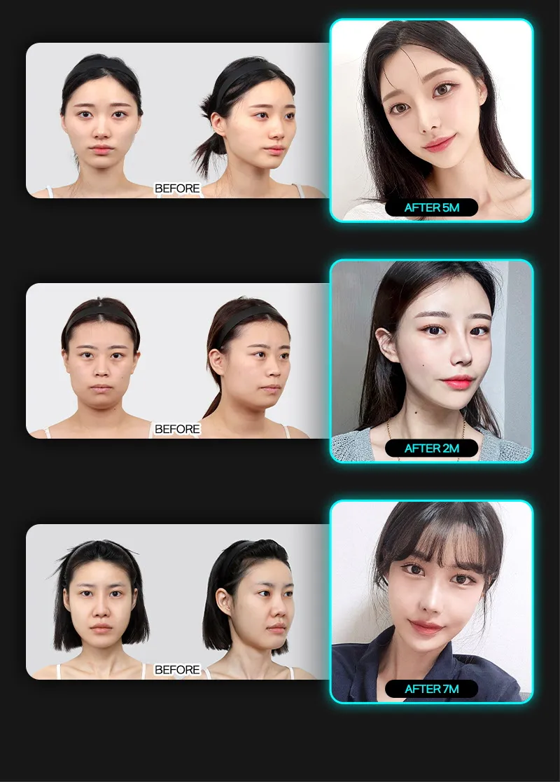 뷰성형외과 ❤️뷰❤️안면윤곽 이벤트, 시술 상세 이미지