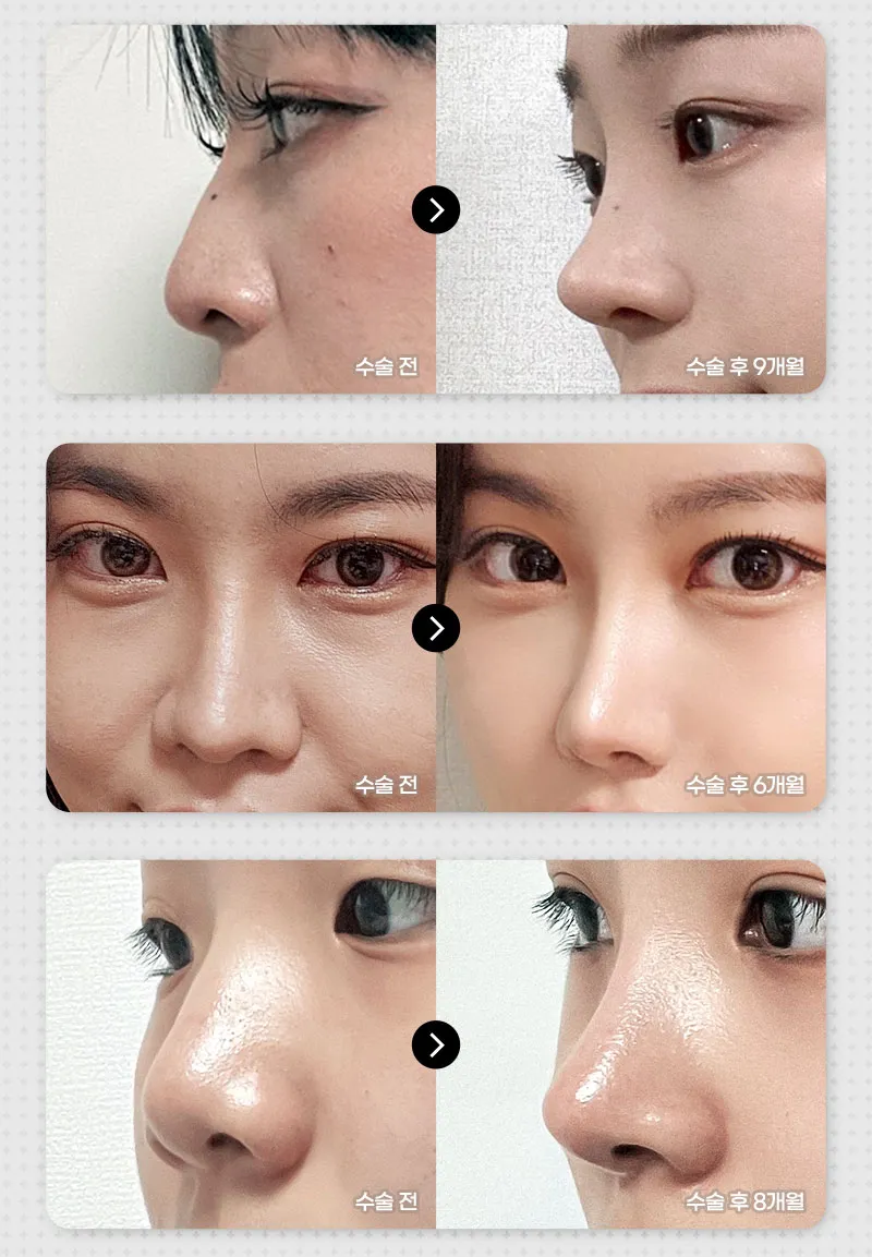 뷰성형외과 ❤️뷰❤️코재수술 이벤트, 시술 상세 이미지