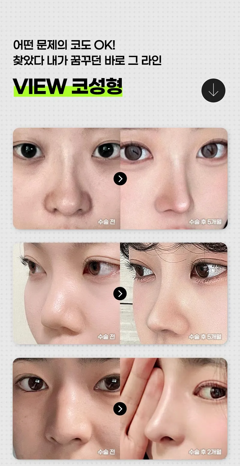 뷰성형외과 ❤️뷰❤️코재수술 이벤트, 시술 상세 이미지