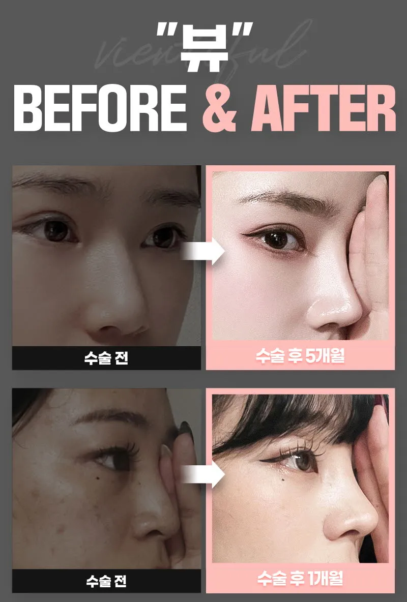 뷰성형외과 ❤️뷰❤️기능코성형 이벤트, 시술 상세 이미지
