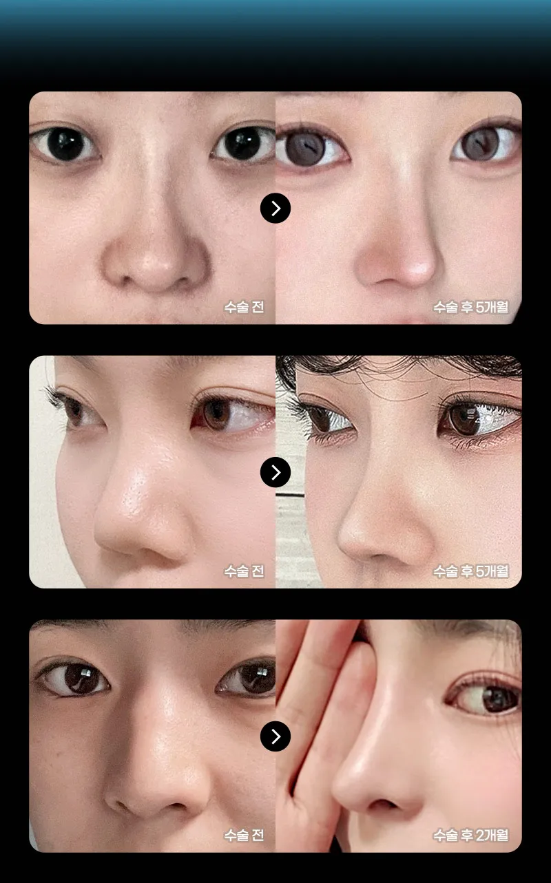 ❤️뷰❤️코성형