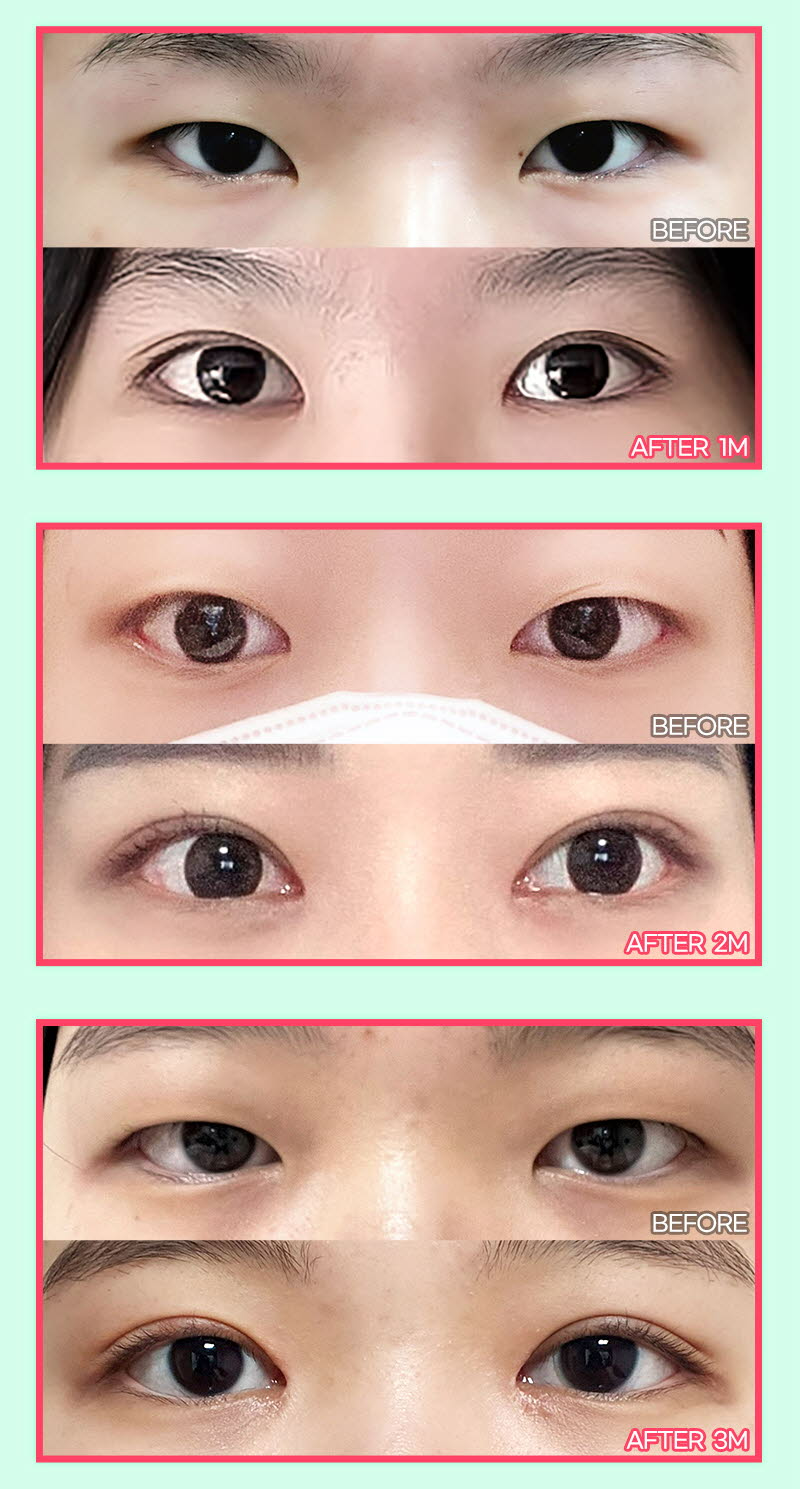 뷰성형외과 ❤️뷰❤️오픈 트임  이벤트, 시술 상세 이미지