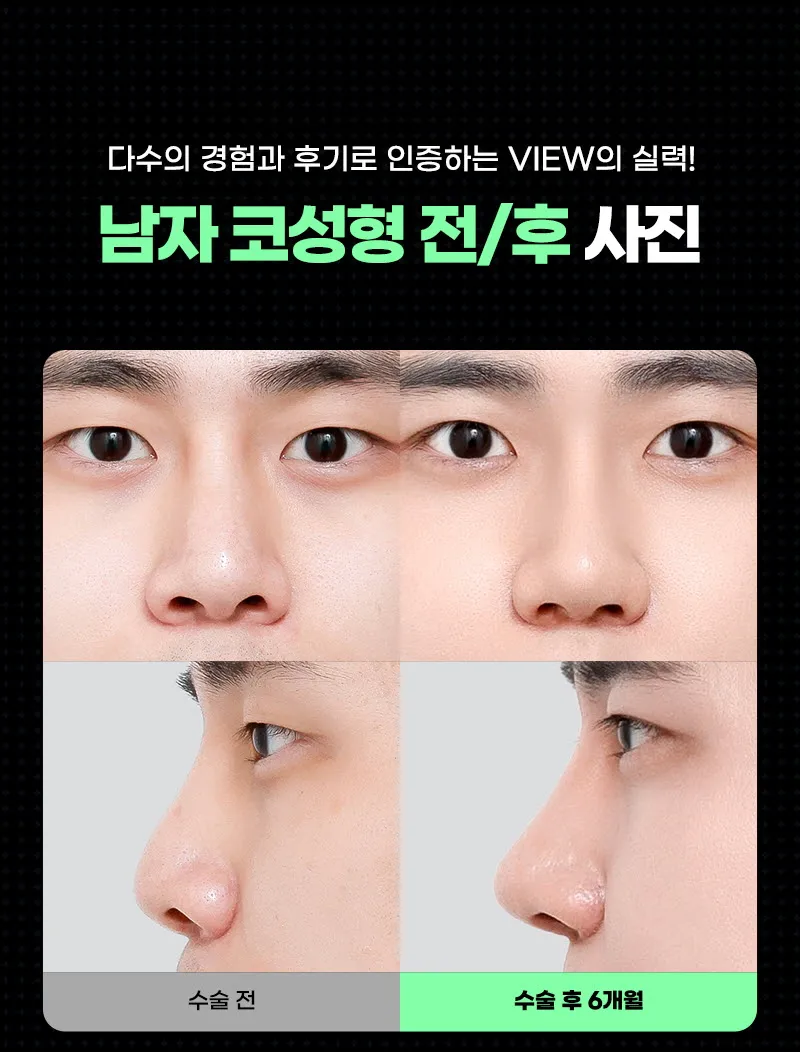 뷰성형외과 ❤️뷰❤️남자코성형 이벤트, 시술 상세 이미지