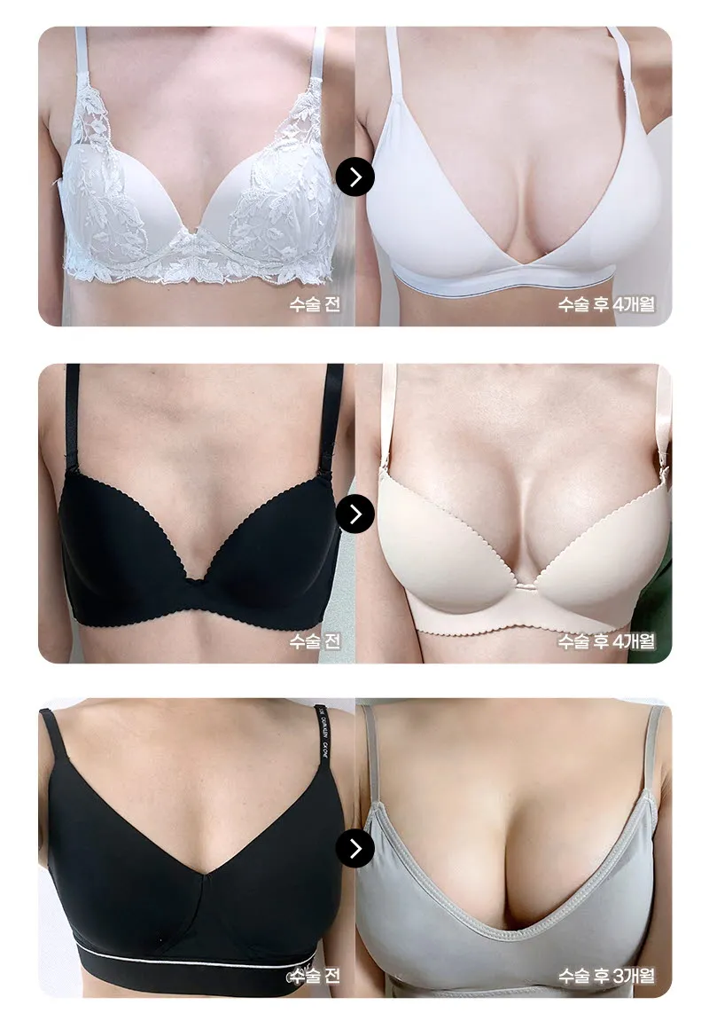 뷰성형외과 ❤️뷰❤️멘토 가슴성형 이벤트, 시술 상세 이미지