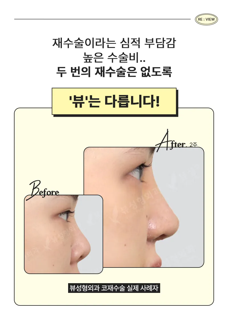 뷰성형외과 ❤️뷰❤️코재수술 이벤트, 시술 상세 이미지