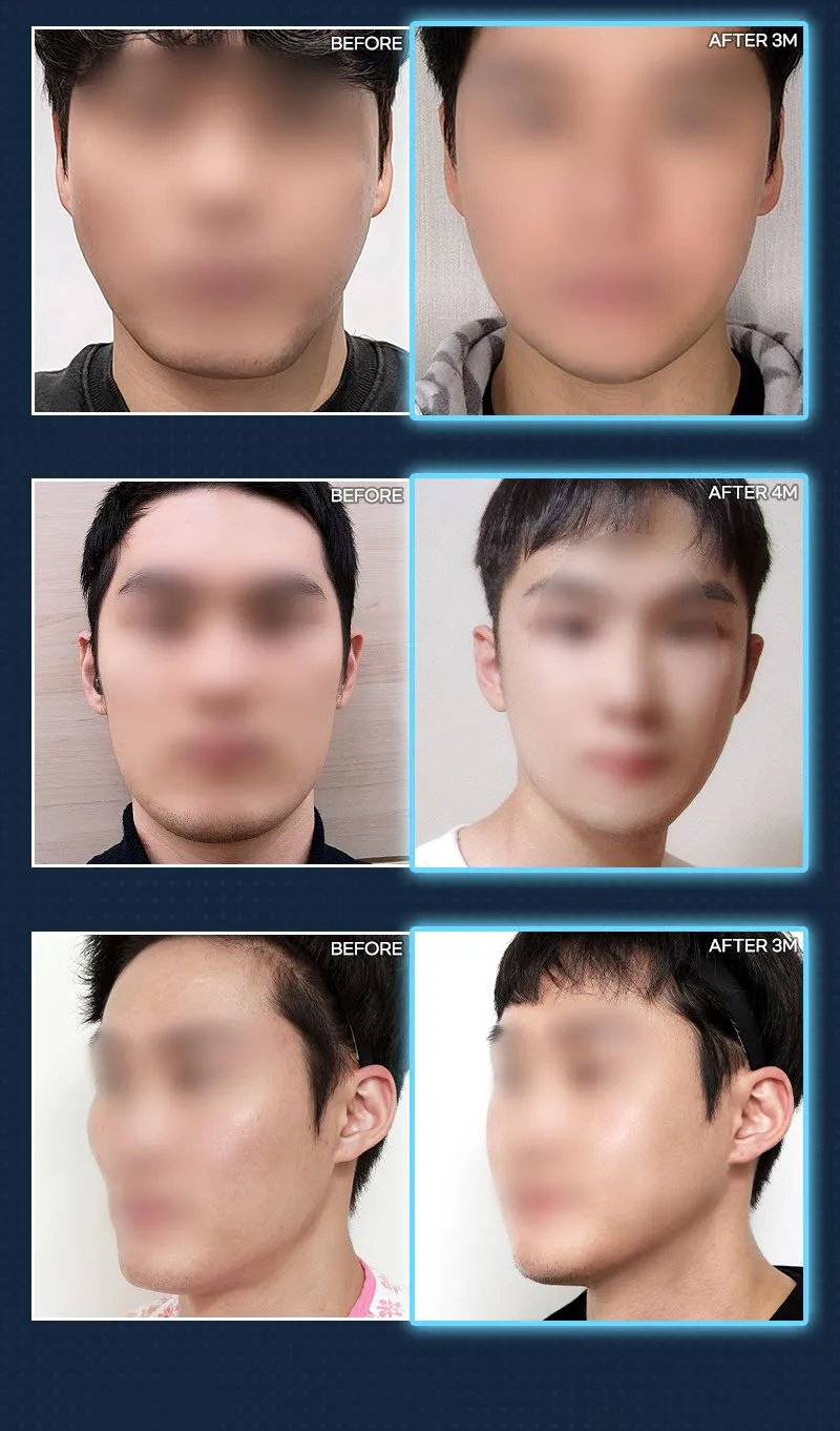 뷰성형외과 ❤️뷰❤️남자 안면윤곽 이벤트, 시술 상세 이미지