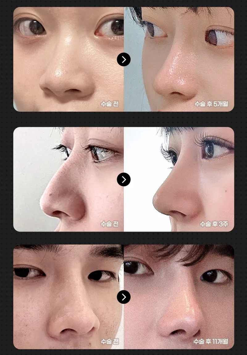 뷰성형외과 ❤️뷰❤️코성형 이벤트, 시술 상세 이미지