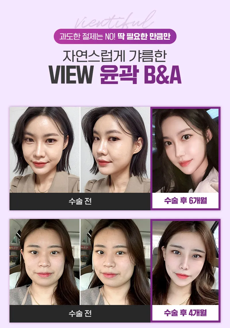 뷰성형외과 ❤️뷰❤️안면윤곽 재수술 이벤트, 시술 상세 이미지