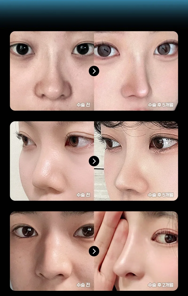 뷰성형외과 ❤️뷰❤️코성형 이벤트, 시술 상세 이미지