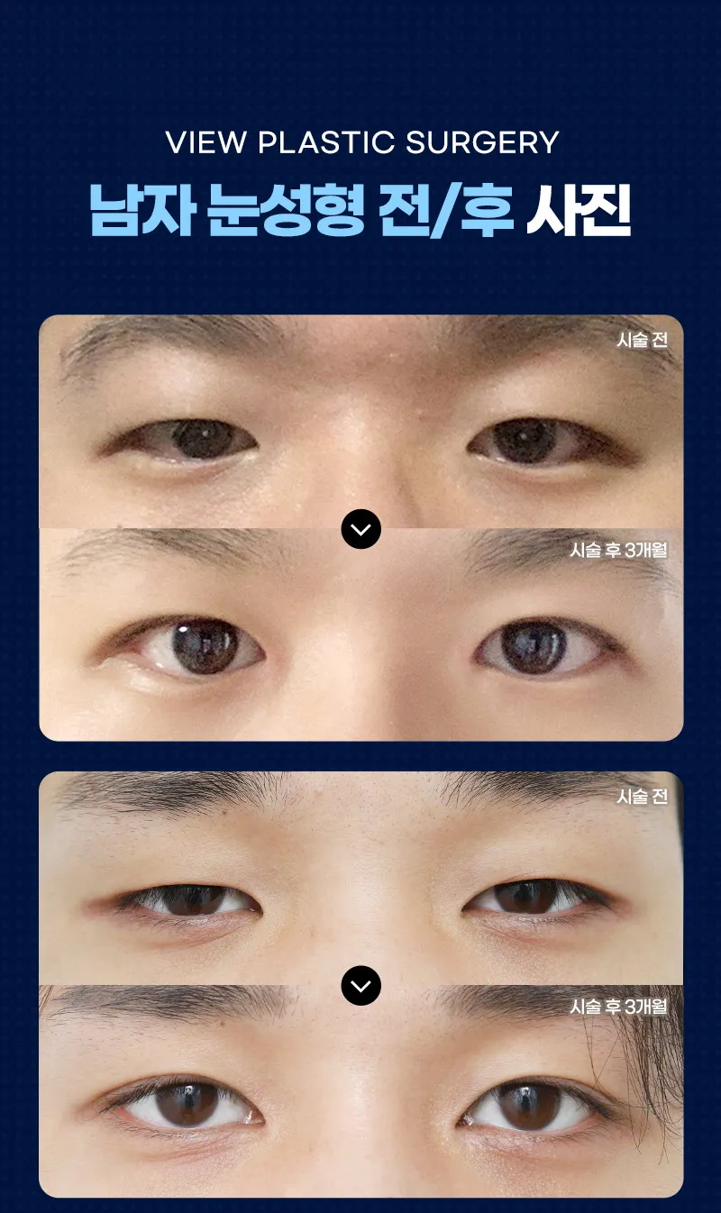 뷰성형외과 ❤️뷰❤️남자 눈성형 이벤트, 시술 상세 이미지
