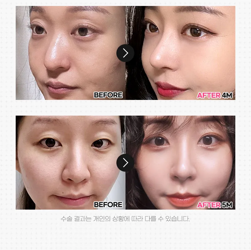 뷰성형외과 ❤️뷰❤️매부리코성형 이벤트, 시술 상세 이미지