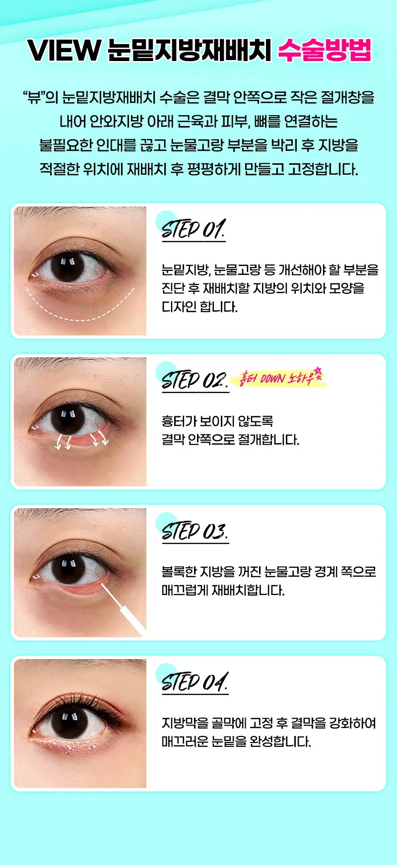 뷰성형외과 ❤️뷰❤️눈밑지방재배치 이벤트, 시술 상세 이미지