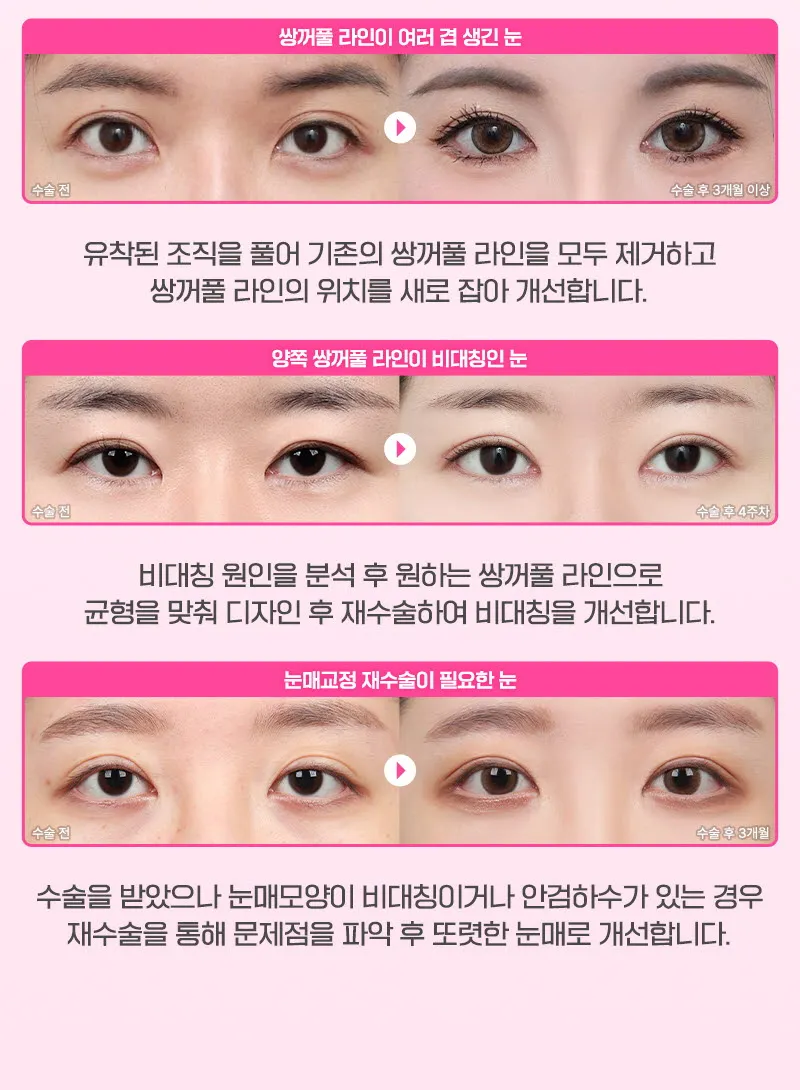 뷰성형외과 ❤️뷰❤️눈재수술 이벤트, 시술 상세 이미지
