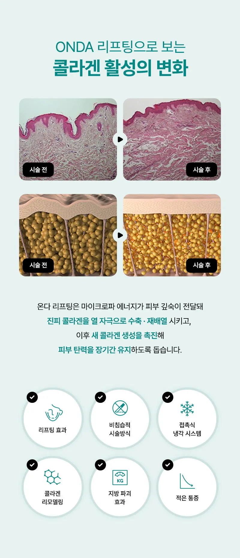 뷰성형외과 ❤뷰❤온다리프팅 이벤트, 시술 상세 이미지