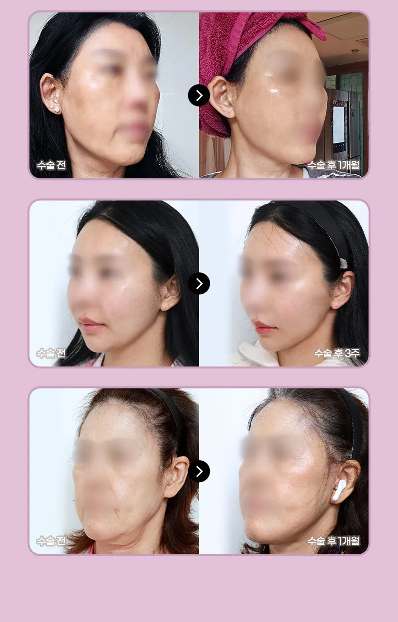 뷰성형외과 ❤뷰❤미니거상 이벤트, 시술 상세 이미지