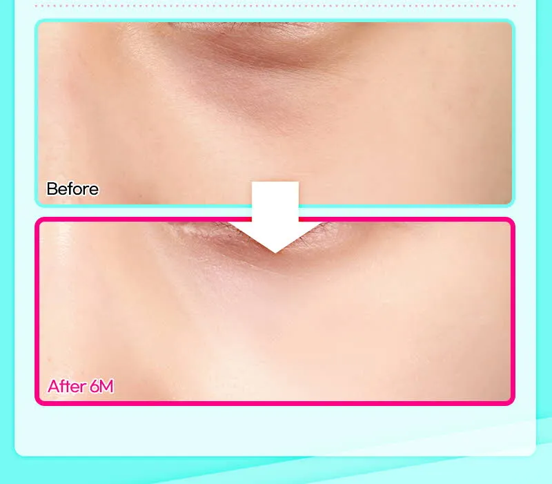 뷰성형외과 ❤️뷰❤️눈밑지방재배치 이벤트, 시술 상세 이미지