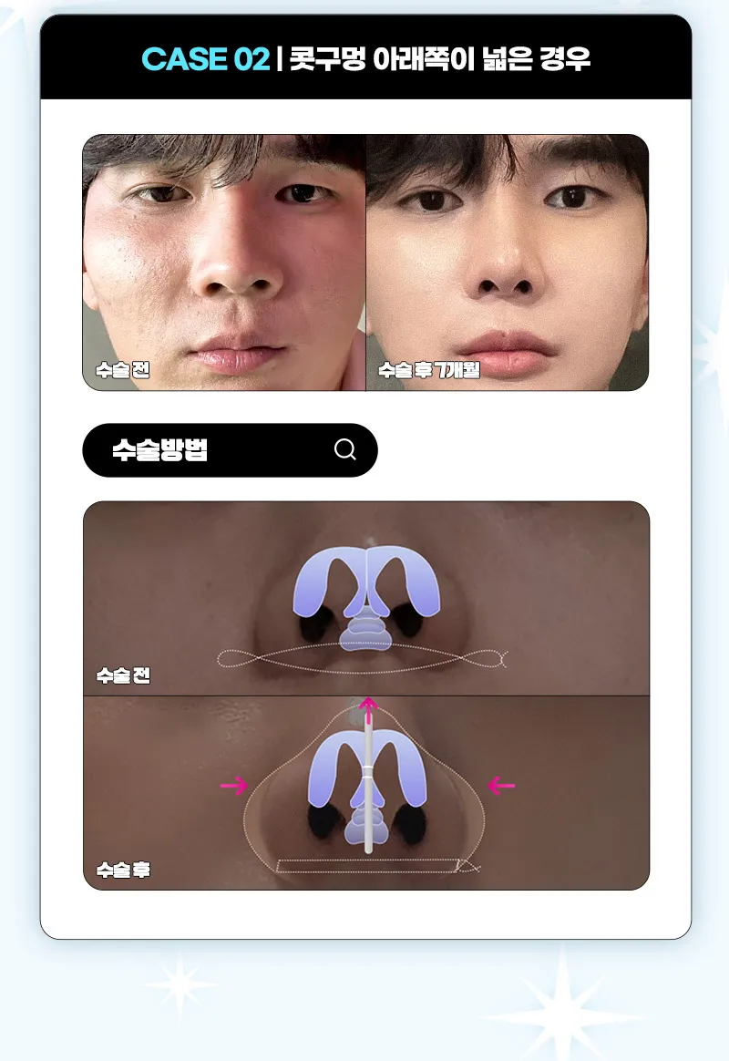 뷰성형외과 ❤️뷰❤️콧볼축소 이벤트, 시술 상세 이미지