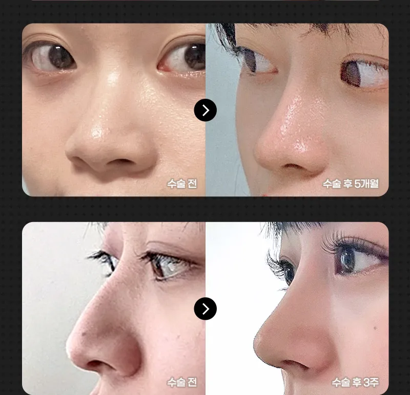 ❤️뷰❤️코성형