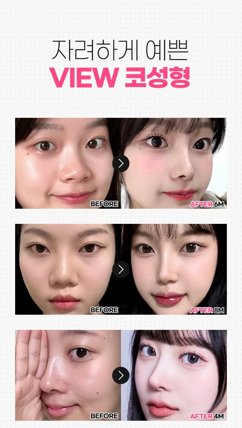 뷰성형외과 ❤️뷰❤️매부리코성형 이벤트, 시술 상세 이미지