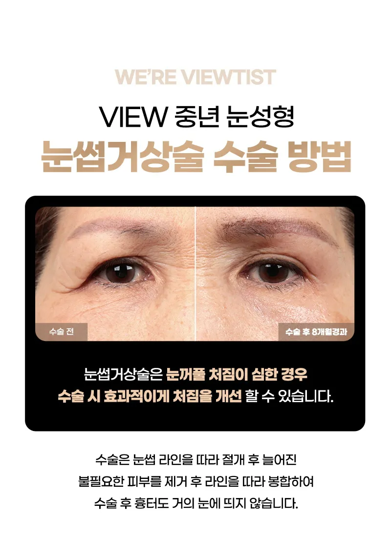 뷰성형외과 ❤️뷰❤️눈썹거상술 이벤트, 시술 상세 이미지