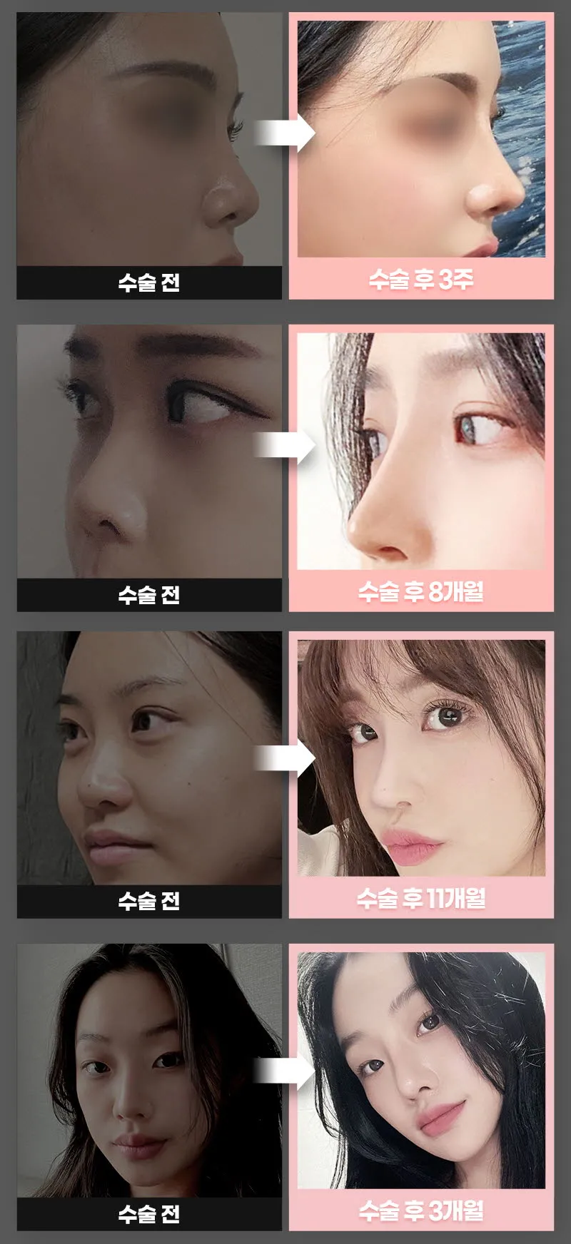 뷰성형외과 ❤️뷰❤️기능코성형 이벤트, 시술 상세 이미지