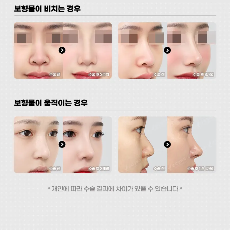 뷰성형외과 ❤️뷰❤️코재수술 이벤트, 시술 상세 이미지