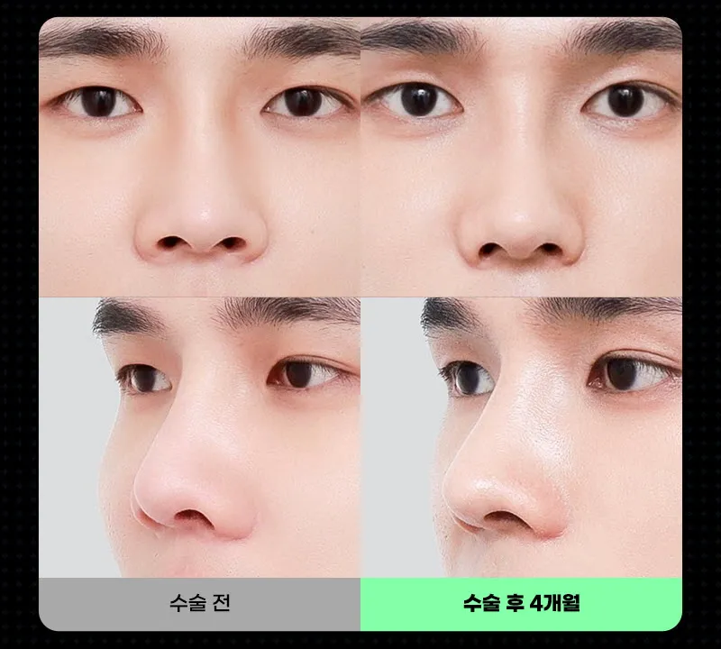 뷰성형외과 ❤️뷰❤️남자코성형 이벤트, 시술 상세 이미지