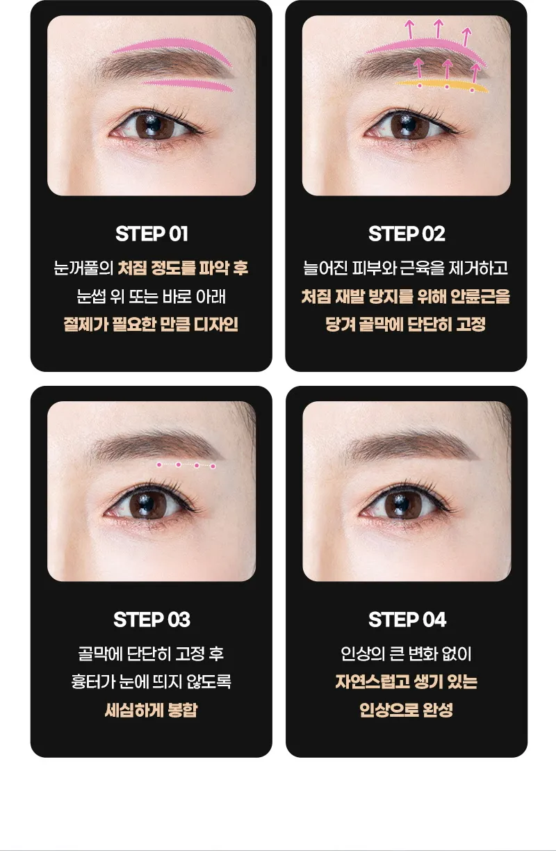 뷰성형외과 ❤️뷰❤️눈썹거상술 이벤트, 시술 상세 이미지