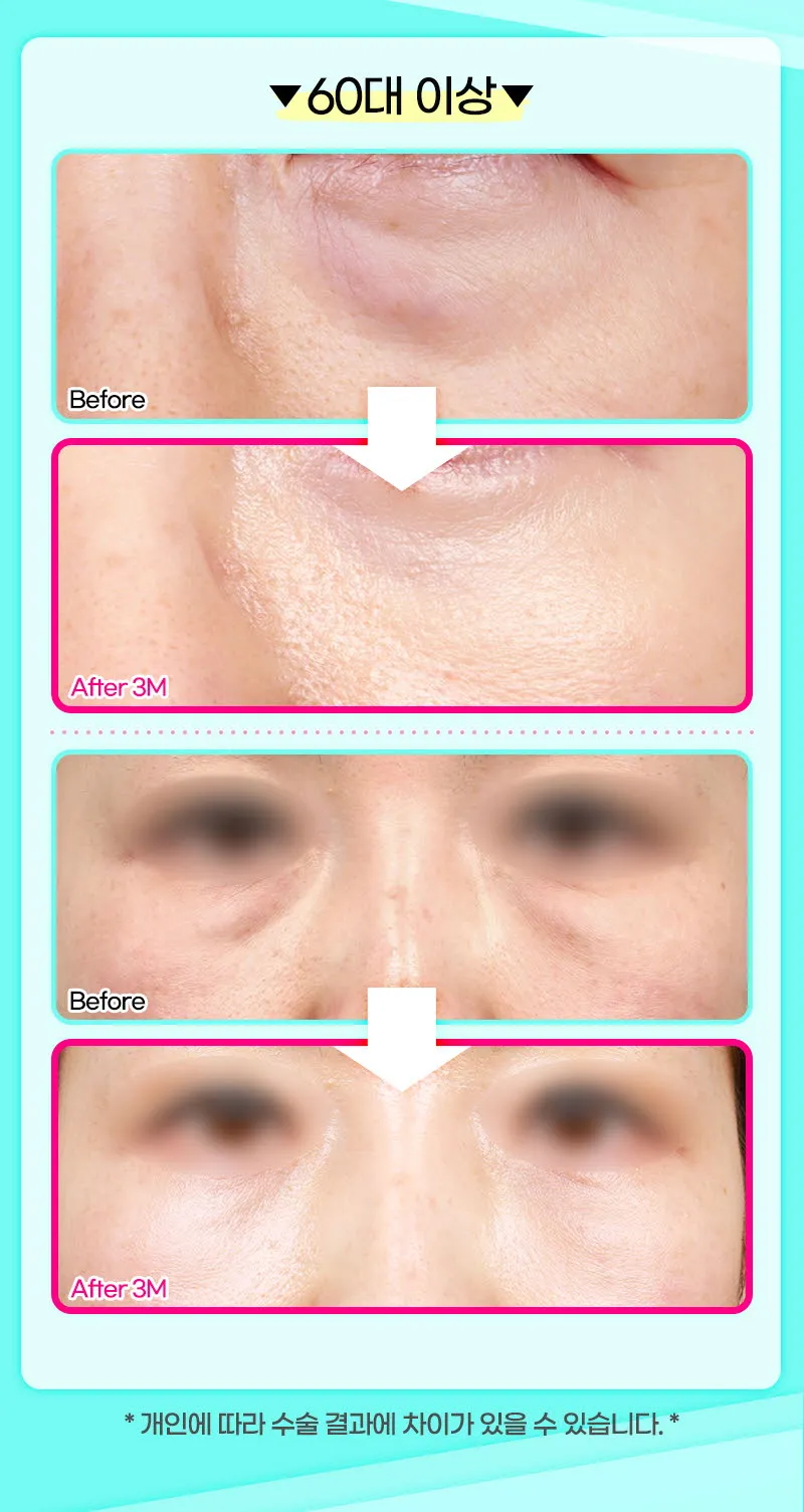 뷰성형외과 ❤️뷰❤️눈밑지방재배치 이벤트, 시술 상세 이미지