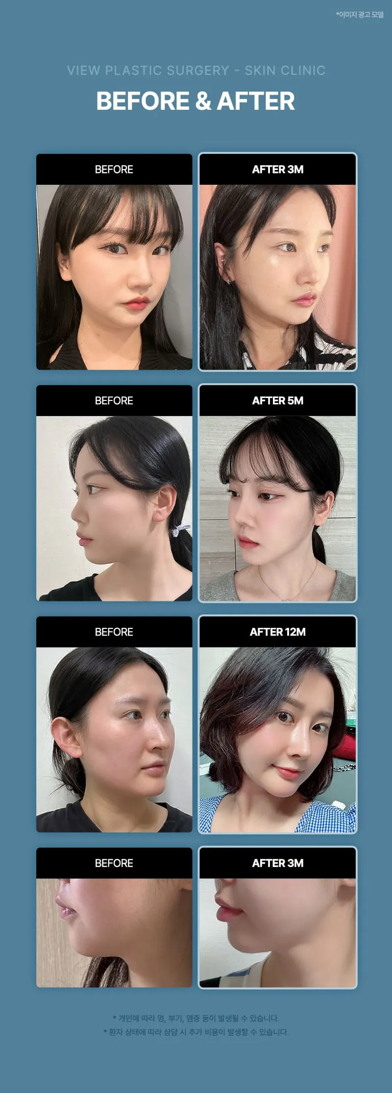 뷰성형외과 ❤뷰❤윤곽주사 이벤트, 시술 상세 이미지