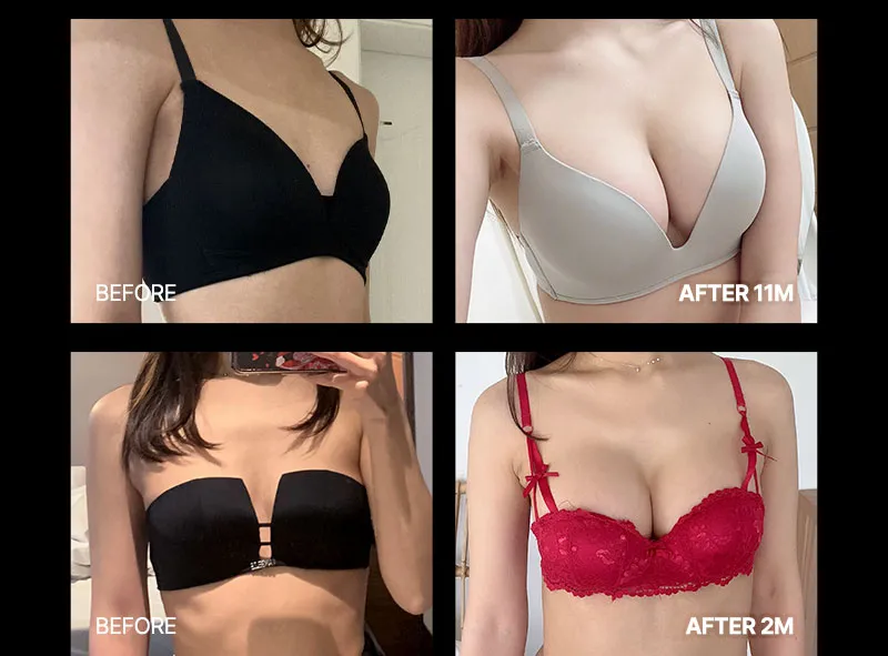 뷰성형외과 ❤뷰❤여의사 UIU 가슴성형 이벤트, 시술 상세 이미지