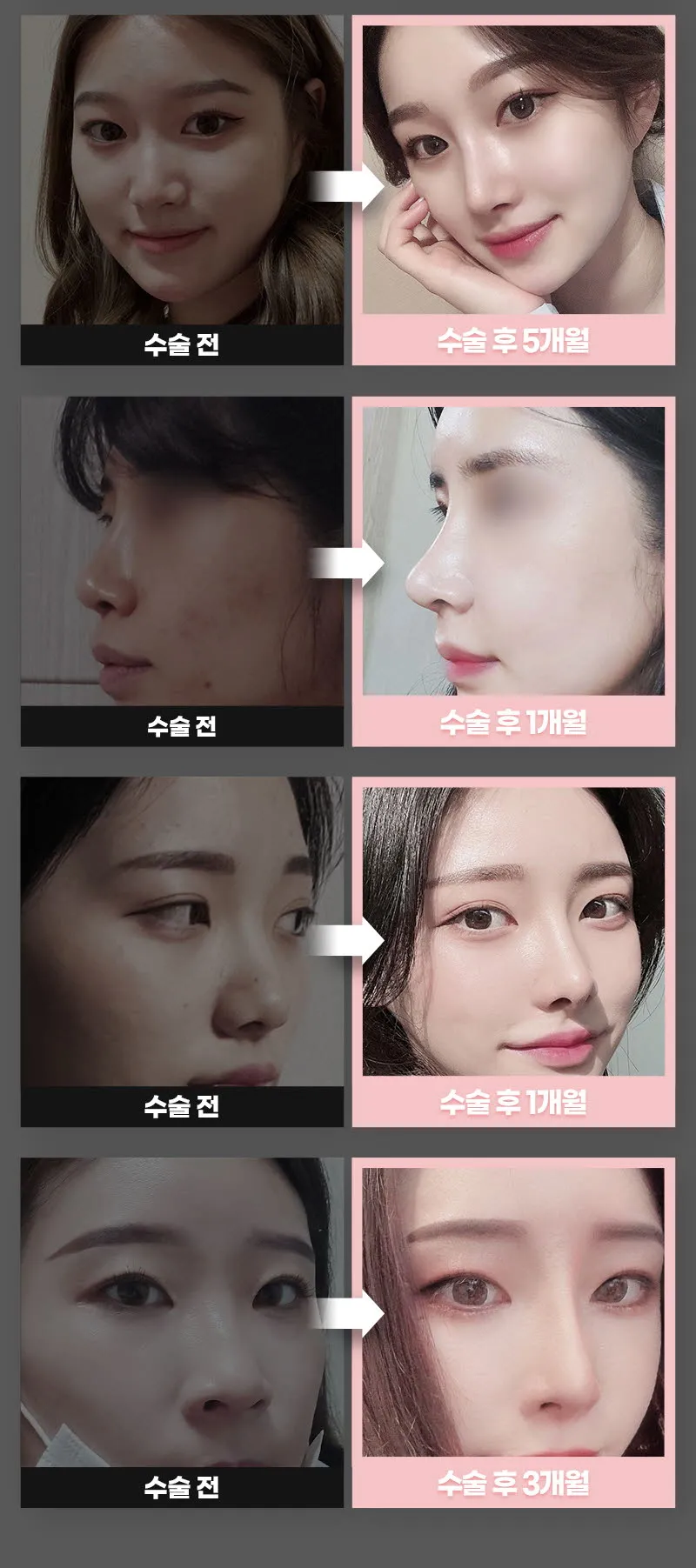 뷰성형외과 ❤️뷰❤️기능코성형 이벤트, 시술 상세 이미지