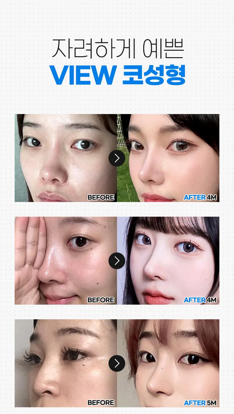 뷰성형외과 ❤️뷰❤️복코성형 이벤트, 시술 상세 이미지